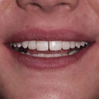 Composite Bonding - Smile 7 before